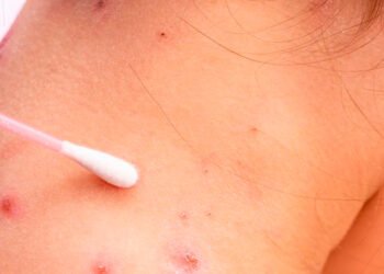 Aumentan casos de Viruela Símica en Ibagué: reportan dos nuevos pacientes positivos