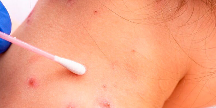 Aumentan casos de Viruela Símica en Ibagué: reportan dos nuevos pacientes positivos