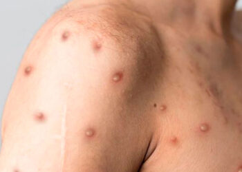 Se confirman dos casos más de Viruela Símica en Ibagué