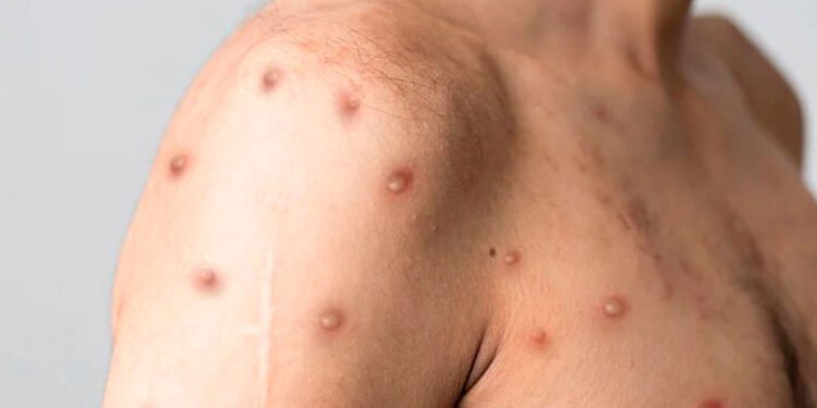 Se confirman dos casos más de Viruela Símica en Ibagué