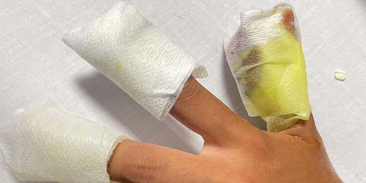 Atención médica oportuna y de calidad a adolescente lesionada por uso de pólvora