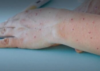 Ibagué suma cuatro casos más de Viruela Símica