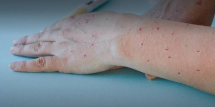 Ibagué suma cuatro casos más de Viruela Símica