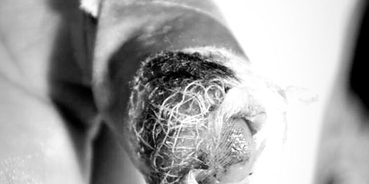 Un hombre de 21 años es el nuevo quemado por pólvora en Ibagué