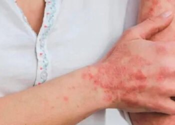 Ibagué no sumó casos de Viruela Símica durante las dos últimas semanas