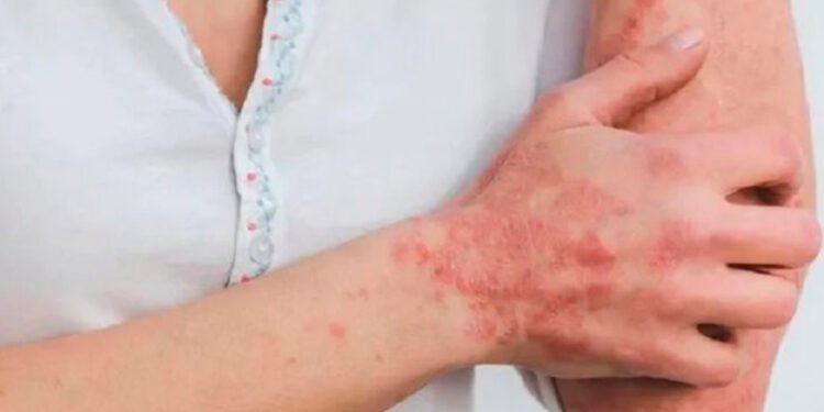 Ibagué no sumó casos de Viruela Símica durante las dos últimas semanas