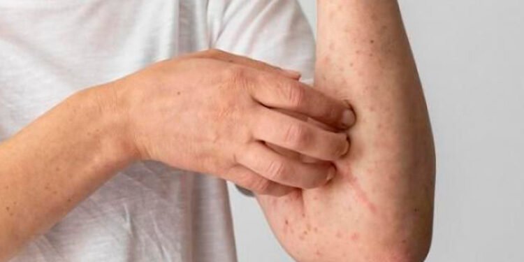 Nuevo contagio por Viruela Símica en Ibagué