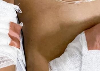 Uno de los heridos del incendio de Picaleña está en cuidados intensivos