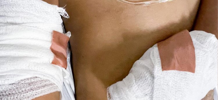 Uno de los heridos del incendio de Picaleña está en cuidados intensivos