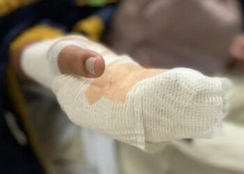 Ibagué ya tiene el primer quemado con pólvora en esta Navidad