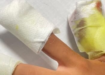 Nuevos quemados con pólvora en Ibagué