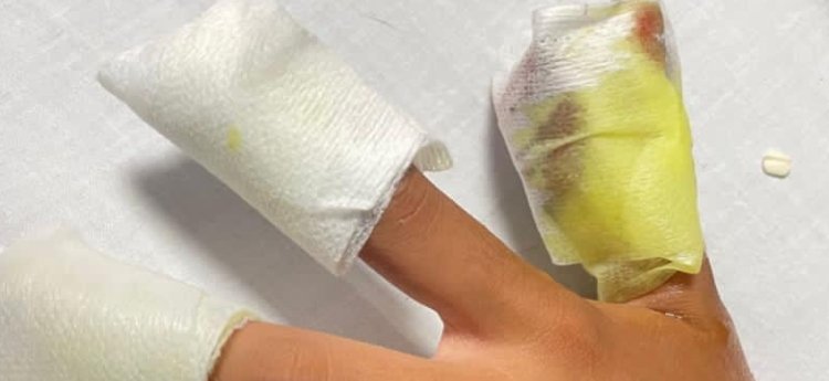 Nuevos quemados con pólvora en Ibagué