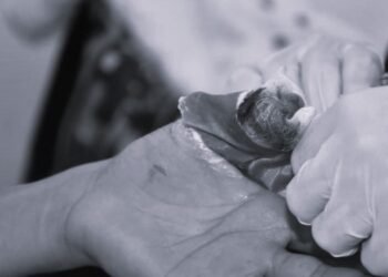 Joven de 14 años es el primer menor de edad quemado con pólvora que se registra en Ibagué