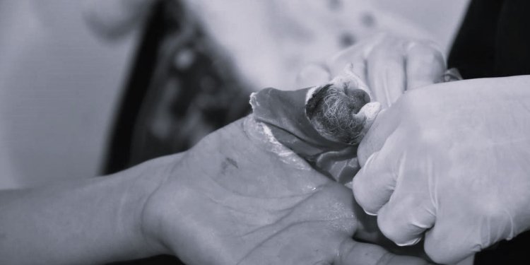 Joven de 14 años es el primer menor de edad quemado con pólvora que se registra en Ibagué