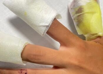 En más de tres veces han aumentado los casos de quemados con pólvora este año