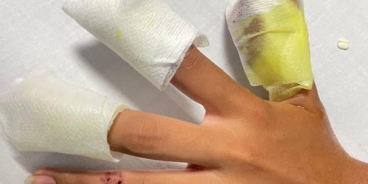 En más de tres veces han aumentado los casos de quemados con pólvora este año