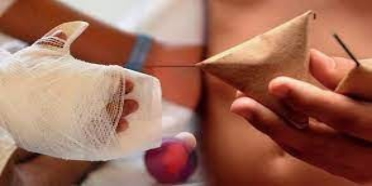 A cinco se eleva ya el número de quemados en Ibagué