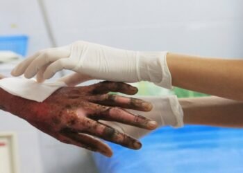 ¡Cuidado con la pólvora! Consejos clave para actuar en caso de quemaduras durante la temporada navideña