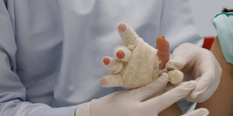 ¡Lamentable! Un nuevo caso de menor de edad quemado con pólvora se registró en Dolores