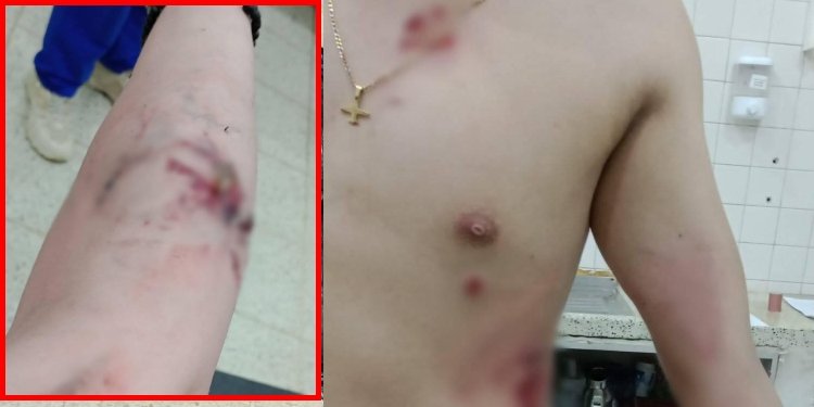 ¡No aprendemos! Nuevo quemado con pólvora en Palocabildo