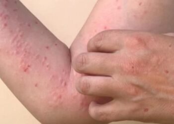 Secretaría de Salud de Ibagué desmintió caso de viruela símica