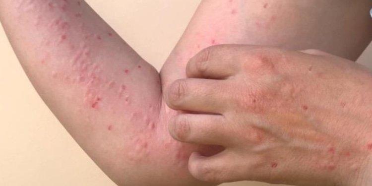 Secretaría de Salud de Ibagué desmintió caso de viruela símica