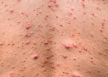 OMS Declara Emergencia Sanitaria Internacional por Brote de Mpox en África: Un Llamado Urgente a la Acción Global