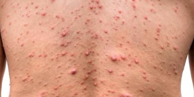 OMS Declara Emergencia Sanitaria Internacional por Brote de Mpox en África: Un Llamado Urgente a la Acción Global