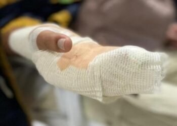 Ya van cuatro personas quemadas con pólvora en Ibagué