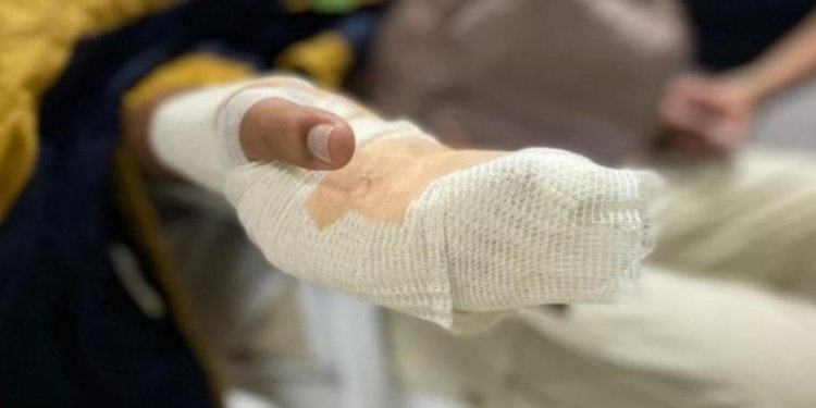 Ya van cuatro personas quemadas con pólvora en Ibagué