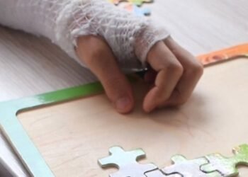 Menor de edad resultó quemado con una mecha que recogió del suelo y le estalló en sus manos