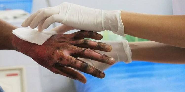 Administración Municipal alerta de prevención y atención por quemaduras y lesiones por pólvora durante fiestas