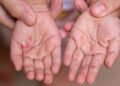 Virus de manos, pies y boca obligó a aislamiento preventivo en dos colegios de Ibagué