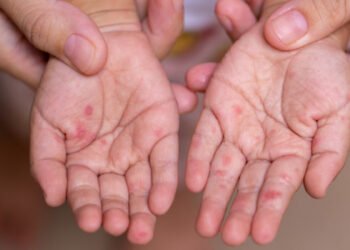 Virus de manos, pies y boca obligó a aislamiento preventivo en dos colegios de Ibagué